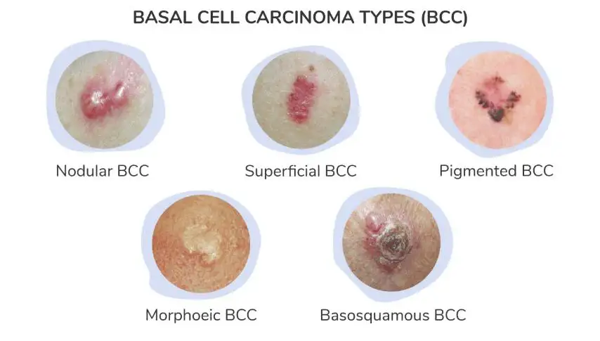 Basal Cell Skin Cancer Treatment: Complete Guide to Options, Prognosis, and Recovery