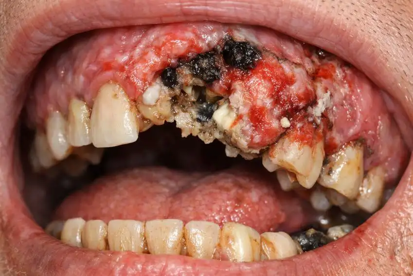 Bone Cancer of the Gums: Symptoms, Causes, Treatment, and Survival Insights