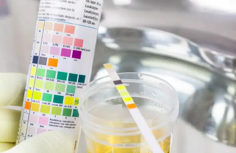 Can Bladder Cancer Be Detected with a Urine Test? A Comprehensive Guide