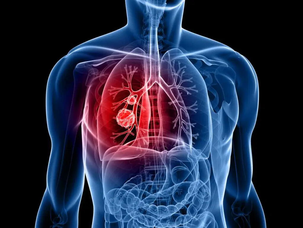 Can Stage 3B Lung Cancer go Into Remission 2026