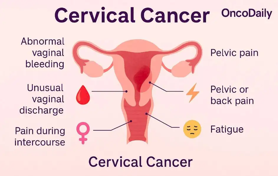 Cervical Cancer Life Expectancy: Diagnosis, Stages, Treatment