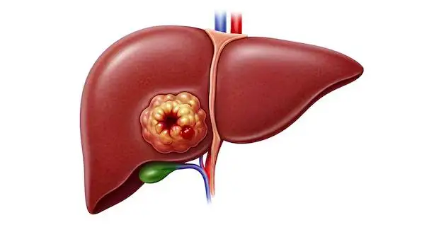 Colon Cancer Metastasis to Liver: Causes, Symptoms, Treatment Options, and Prognosis