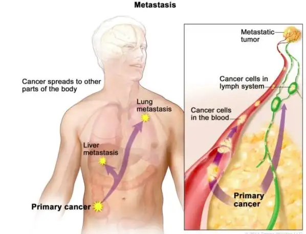 Colon Cancer Spread to Lungs – Symptoms, Treatment Options