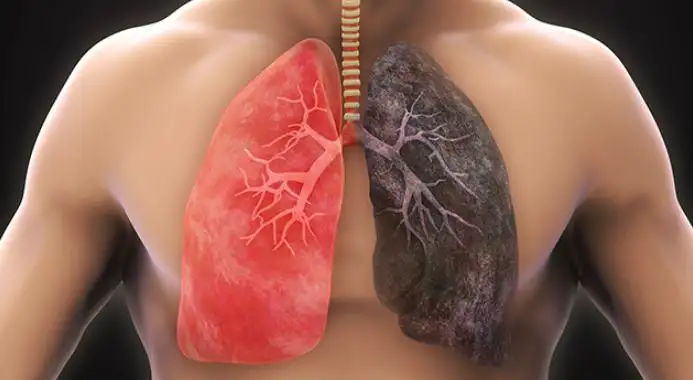 Does Bronchiectasis Cause Lung Cancer? Understanding the Link, Risks, and What You Should Know