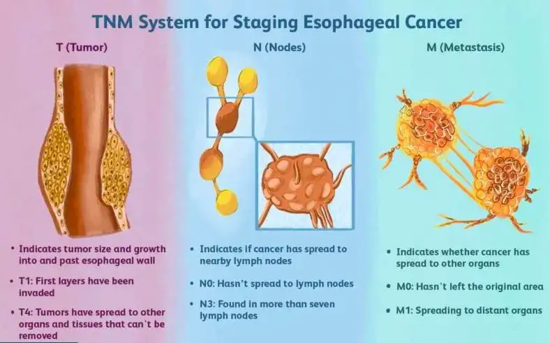 Esophageal Cancer Spreads to The Lungs 2026