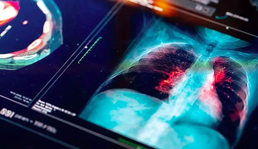 How Fast Does Lung Cancer Spread? Timeline, Stages, and What You Need