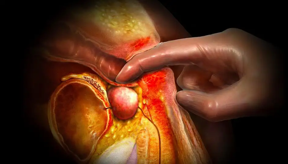 how to detect prostate cancer: Causes and Risk Factors