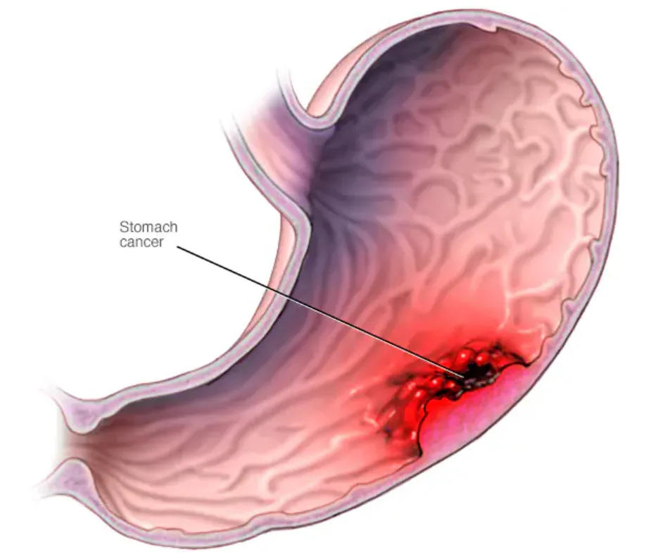 Stomach Cancer Stage 4 Survival Rates: What You Need to Know