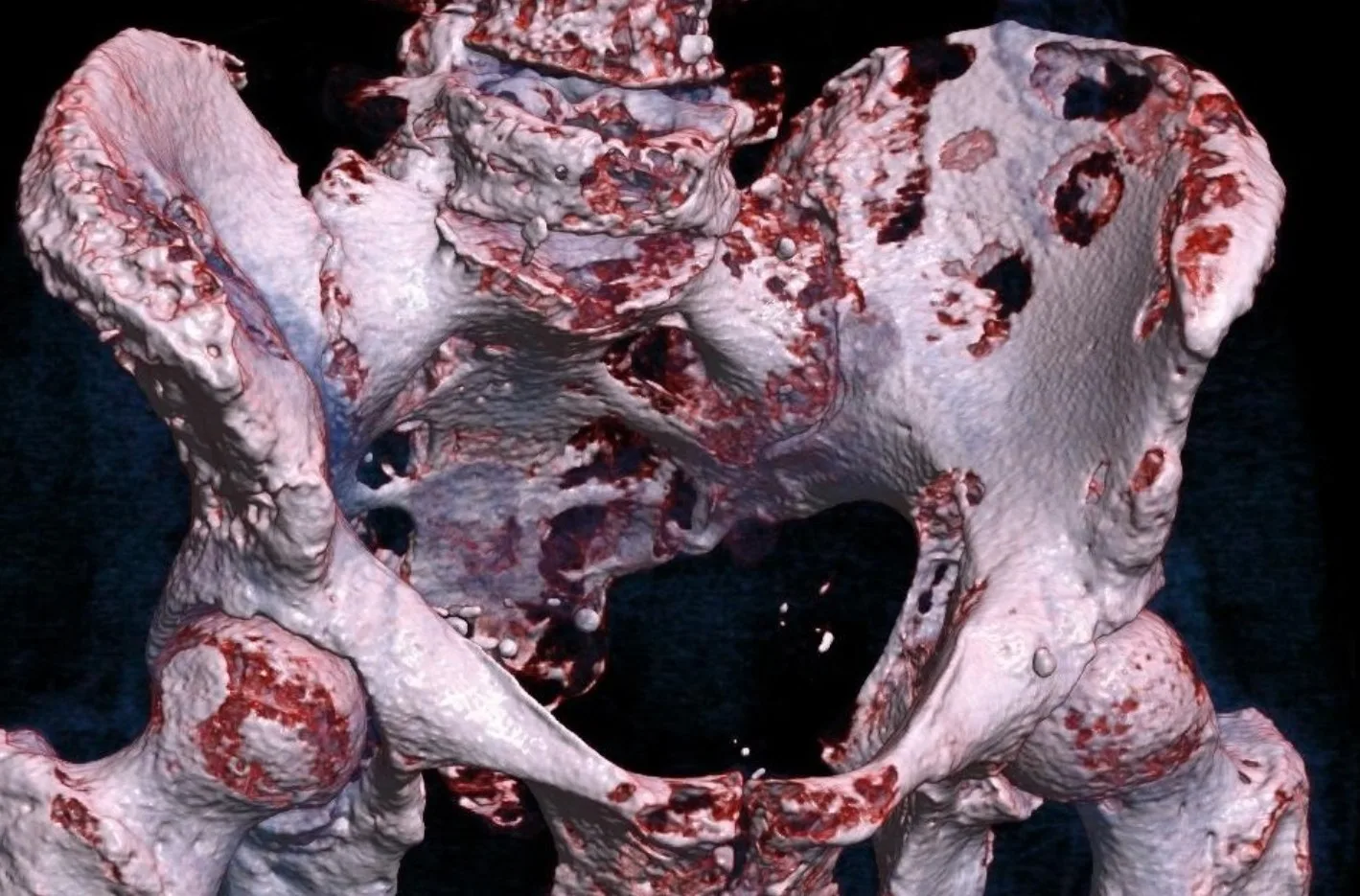 Bone Cancer Melanoma: A Comprehensive Guide for Patients and Families