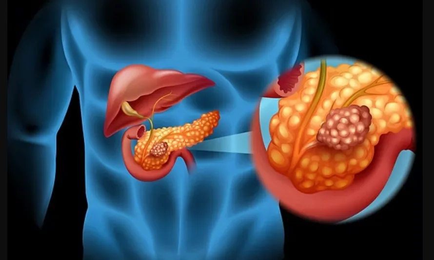 Pancreatic and Liver Cancer Final Stages: Causes and Risk Factors