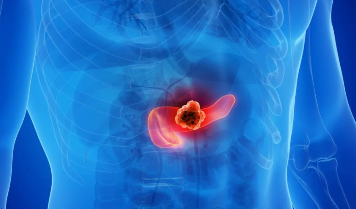 How Is Pancreatic Cancer Diagnosed? A Complete Guide