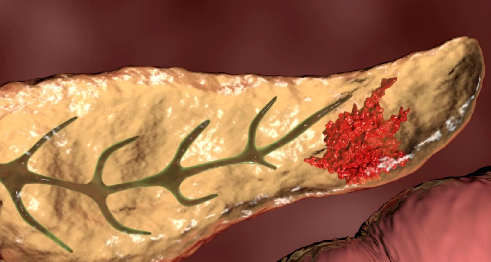 Nivolumab Pancreatic Cancer: Symptoms, Causes, Treatment, Prognosis
