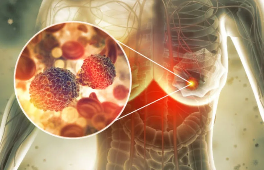 Pertuzumab Breast Cancer: Causes and Risk Factors