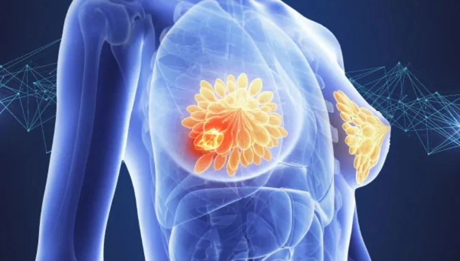 Molecular Subtypes of Breast Cancer: Causes and Risk Factors