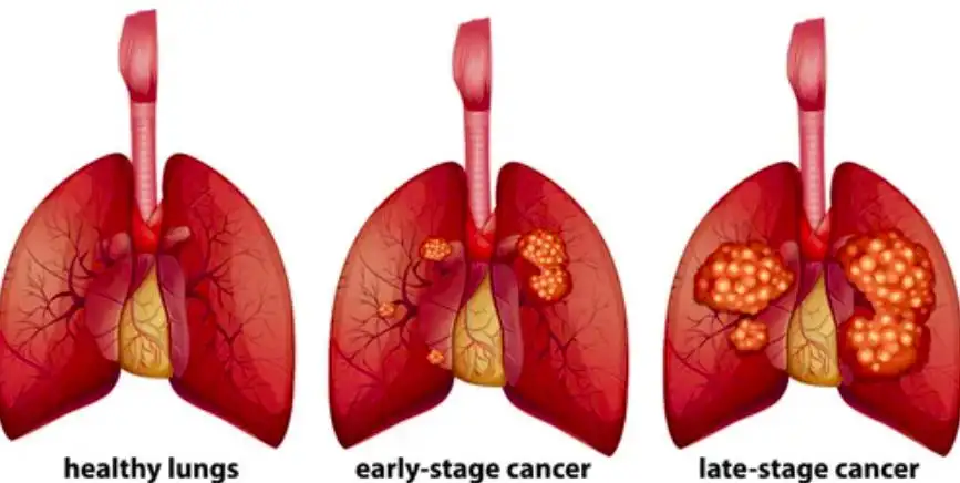 Late-Stage Small Cell Lung Cancer: Symptoms, and Treatment