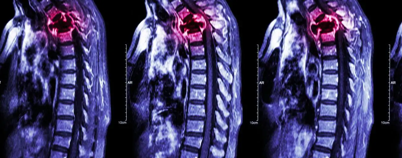 Lung Cancer Spread to Bone Life Expectancy 2026