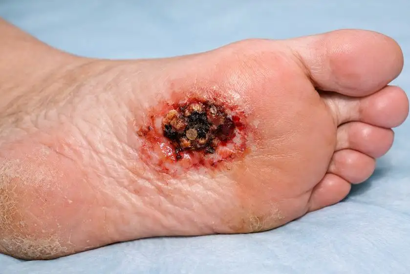 Skin Cancer on Bottom of Foot: Causes, Symptoms, Diagnosis, and Effective Treatment Options
