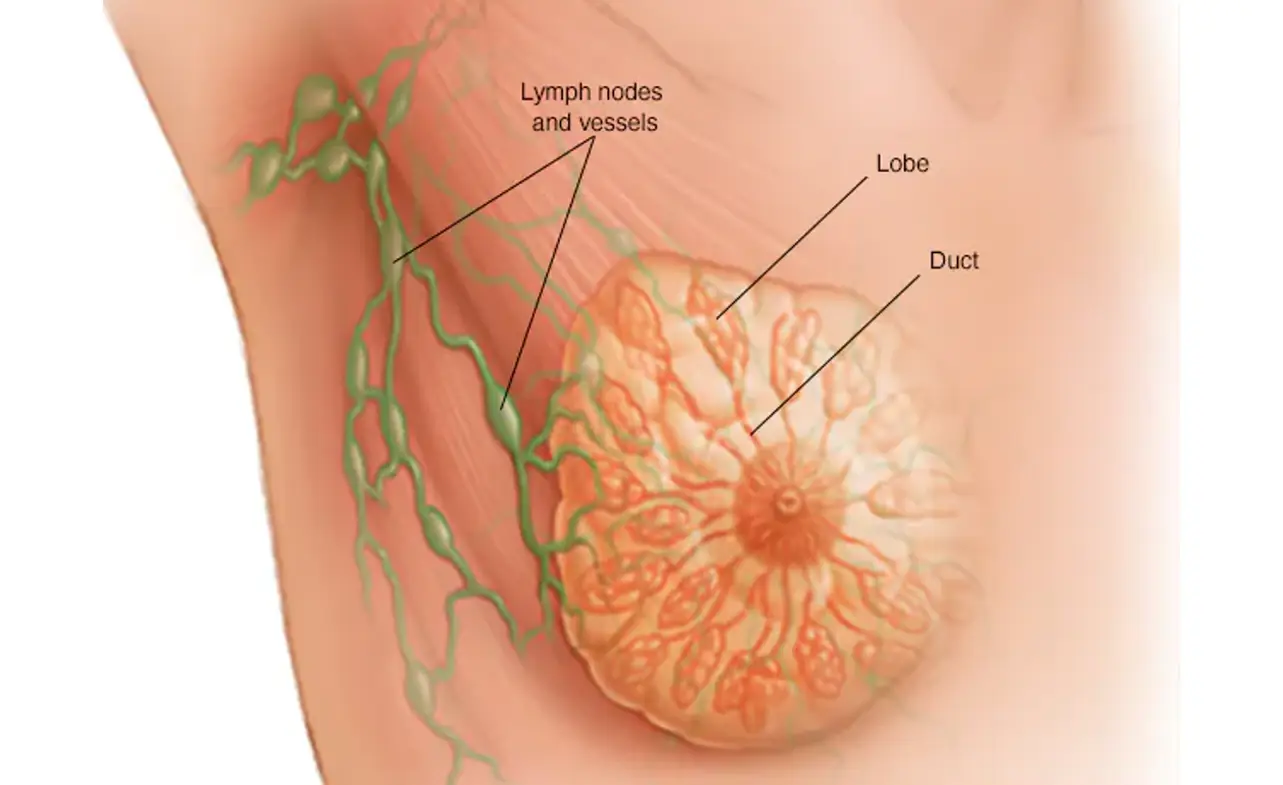 Stage 4 Breast Cancer Life Expectancy Without Treatment