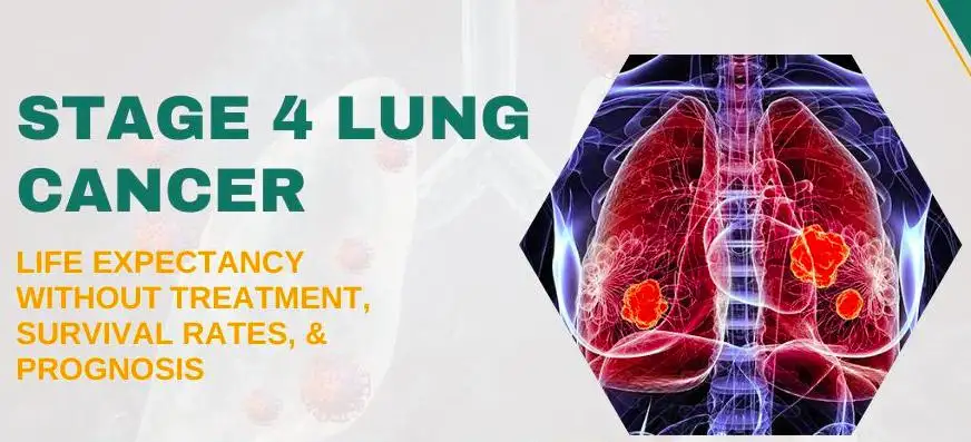 Stage 4 Lung Cancer Life Expectancy Without Treatment