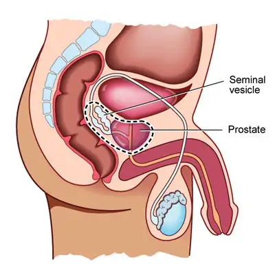 Stage 4 Prostate Cancer Metastasized to Bone: Comprehensive Guide to Symptoms, Treatments, and Living Well