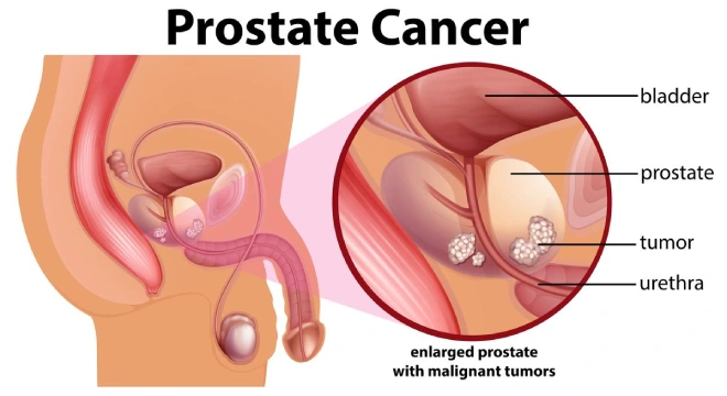 Stage 4 Prostate Cancer Spread to Bones Life Expectancy