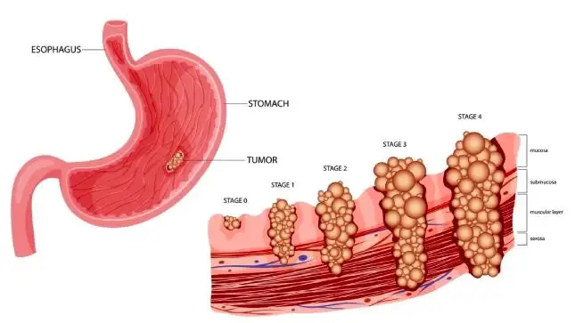 Stage 4 Stomach Cancer Survival Rates: Prognosis, Treatment Options, and What Patients Need to Know
