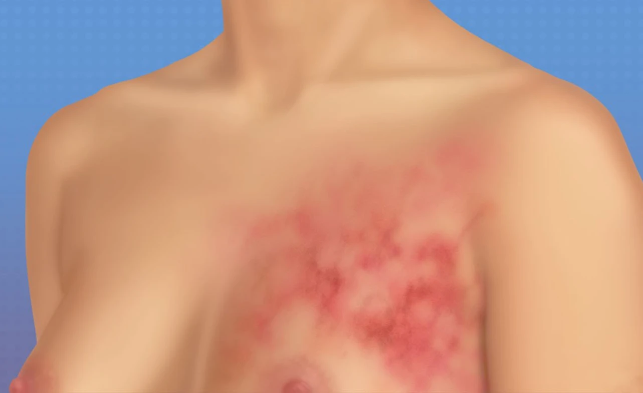 Survival Rate of Stage 3 Breast Cancer 2026