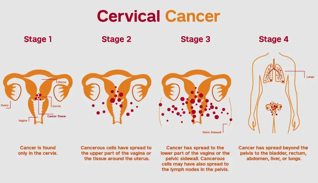Treatment for Stage 3 Cervical Cancer 2026