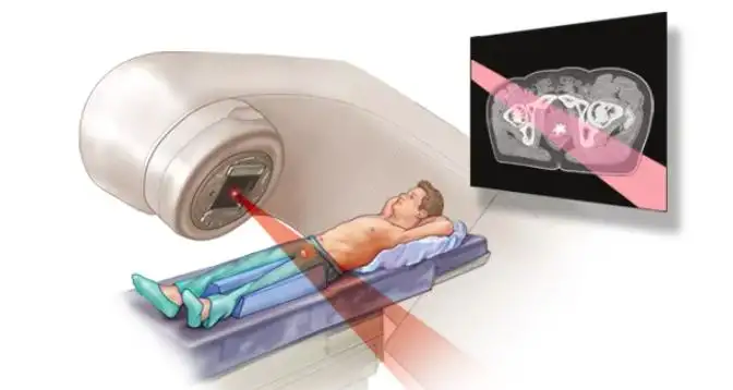 What Are the After Effects of Radiation for Prostate Cancer? Causes and Risk Factors