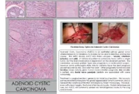 Adenoid Cystic Carcinoma Prognosis