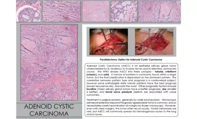 Adenoid Cystic Carcinoma Prognosis