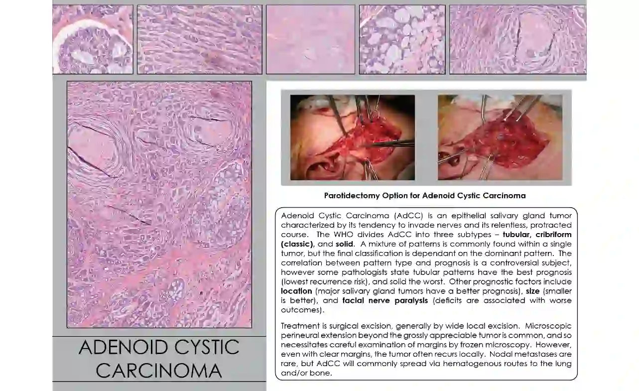 Adenoid Cystic Carcinoma Prognosis