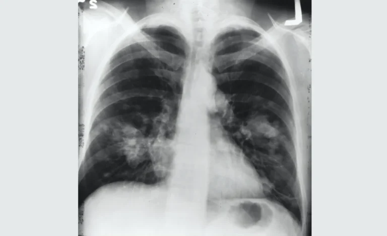 Alternative Treatment for Lung Cancer Stage 4