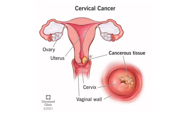 Cervical Cancer Life Expectancy