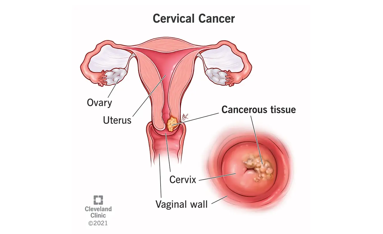 cervical-cancer-life-expectancy-diagnosis-stages-treatment