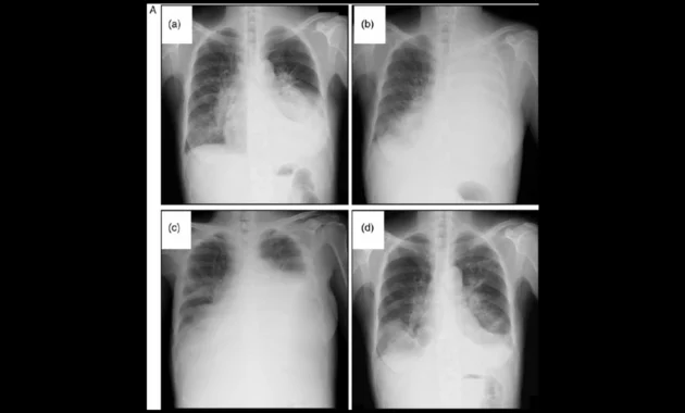 Crizotinib Lung Cancer