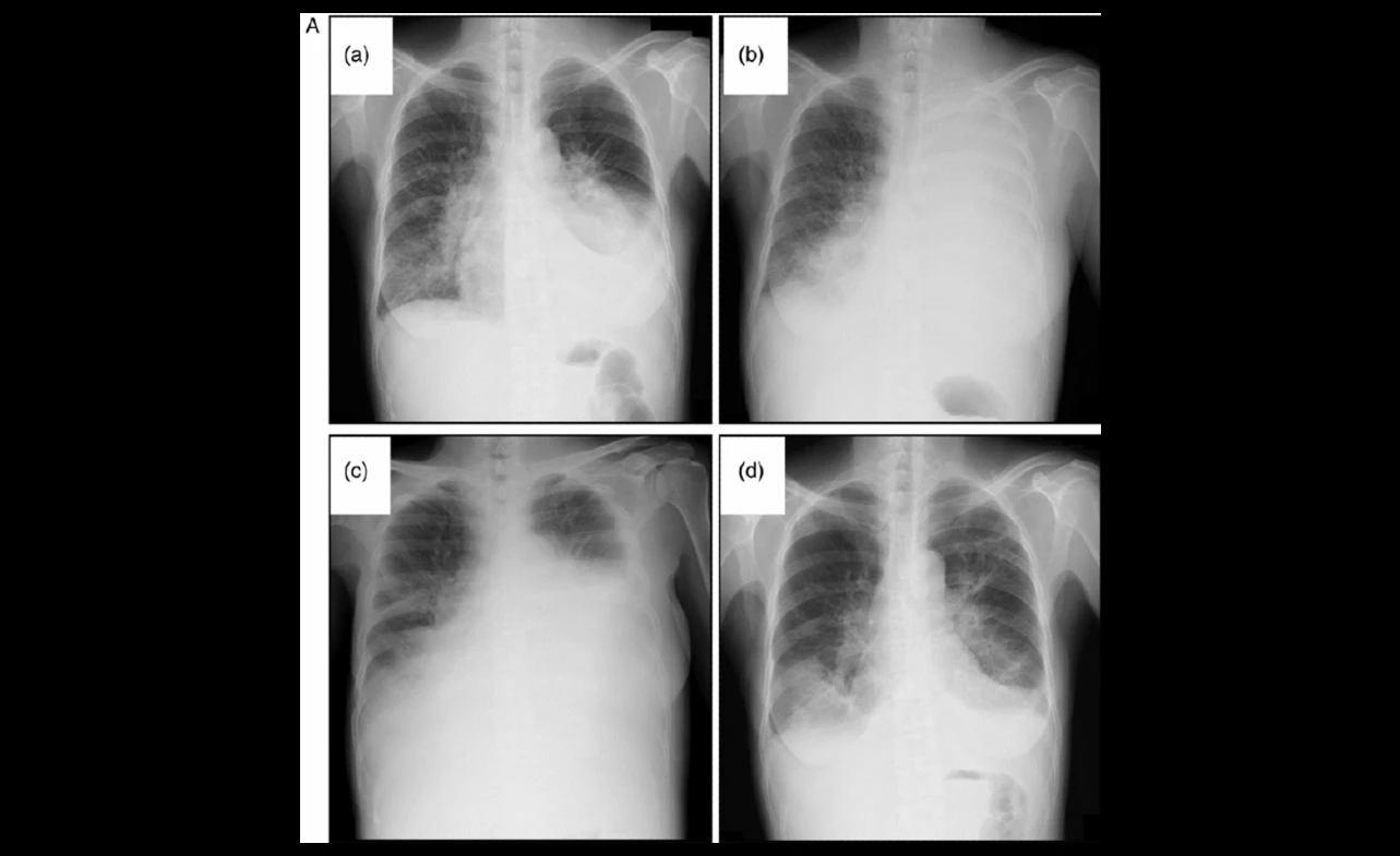 Crizotinib Lung Cancer