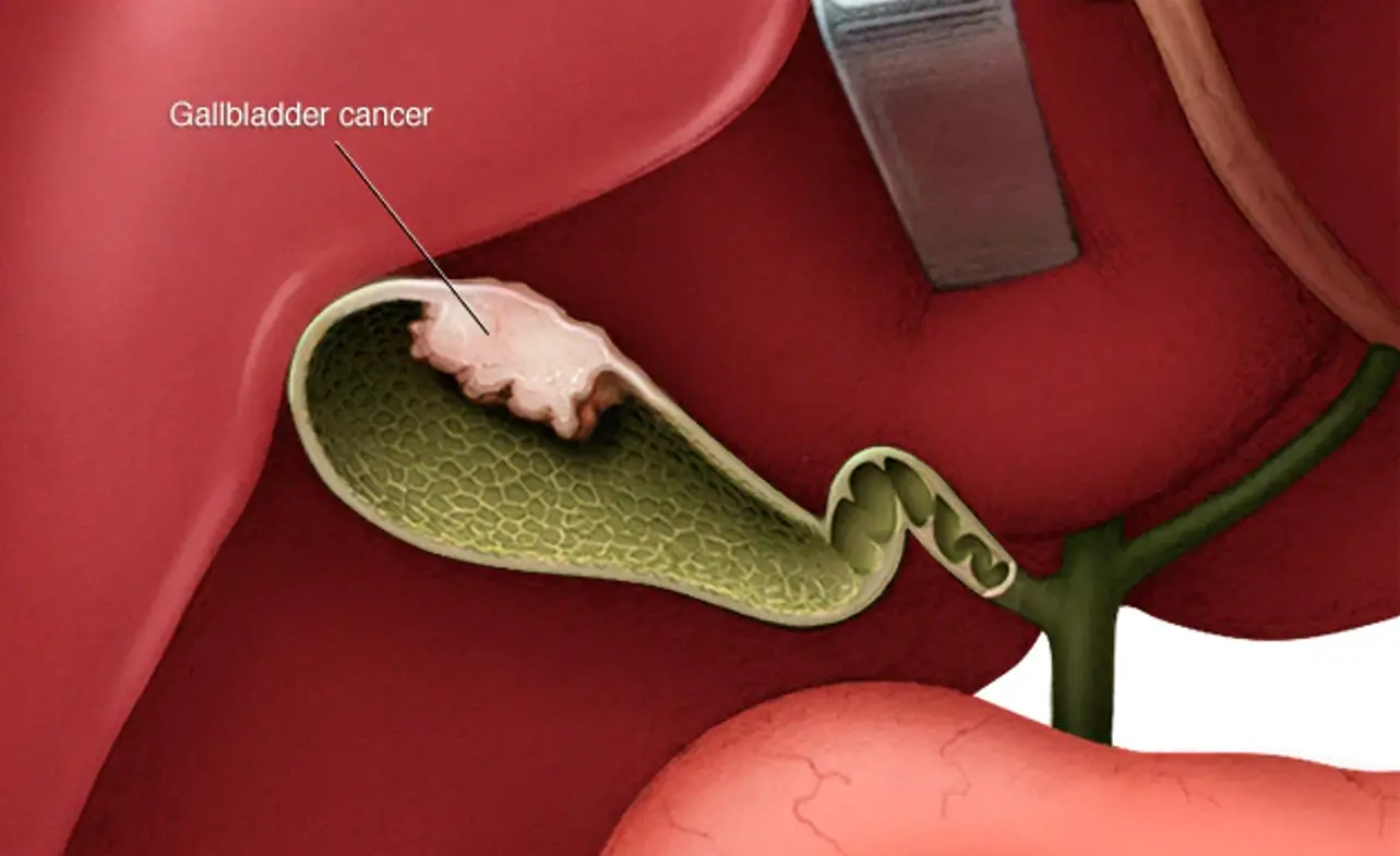 gallbladder-cancer-stage-4-life-expectancy-2024