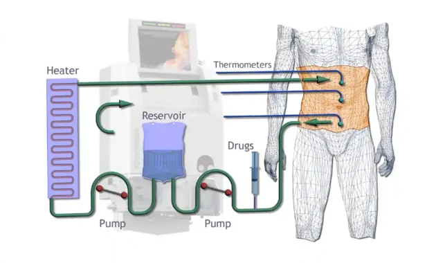 HIPEC Treatment for Colorectal Cancer