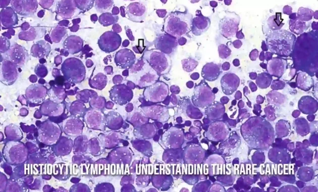 Histiocytic Lymphoma