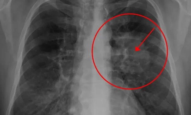 How Long Can You Live With Lung Cancer Without Treatment