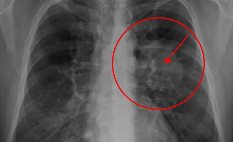 How Long Can You Live With Lung Cancer Without Treatment