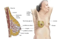 Is Stage 3 Breast Cancer Curable