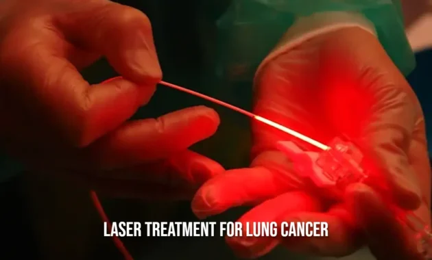 Laser Treatment for Lung Cancer