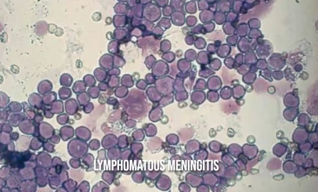 Lymphomatous Meningitis