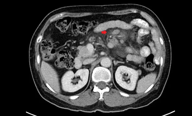 Mesenteric Lymphoma