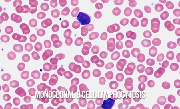 Monoclonal B Cell Lymphocytosis