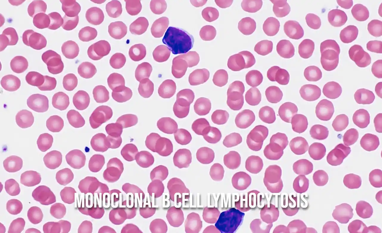 Monoclonal B Cell Lymphocytosis: Diagnosis, Progression, Research Insights