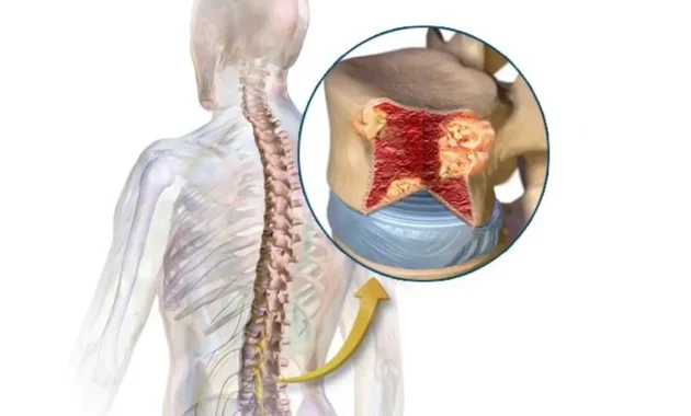 Multiple Myeloma Symptoms Rash