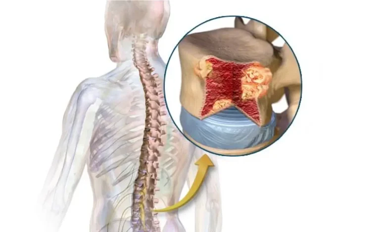 Multiple Myeloma Symptoms Rash